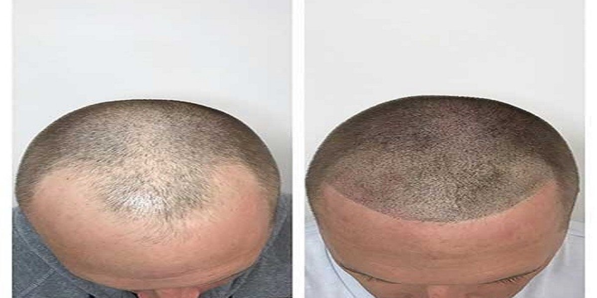 Hair Loss Alert: Don’t Ignore the Early Signs of Male Pattern Baldness