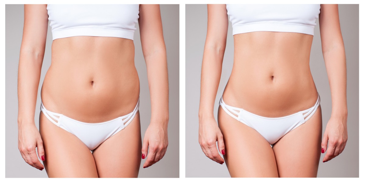 7 Things to Look for When Choosing a Liposuction Clinic in Islamabad: What’s the Difference?