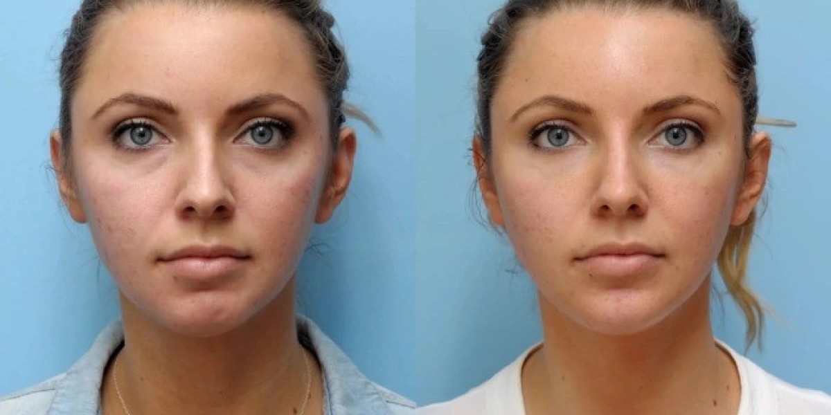 Premium Thread Lift Solutions from the Best Doctors in Dubai