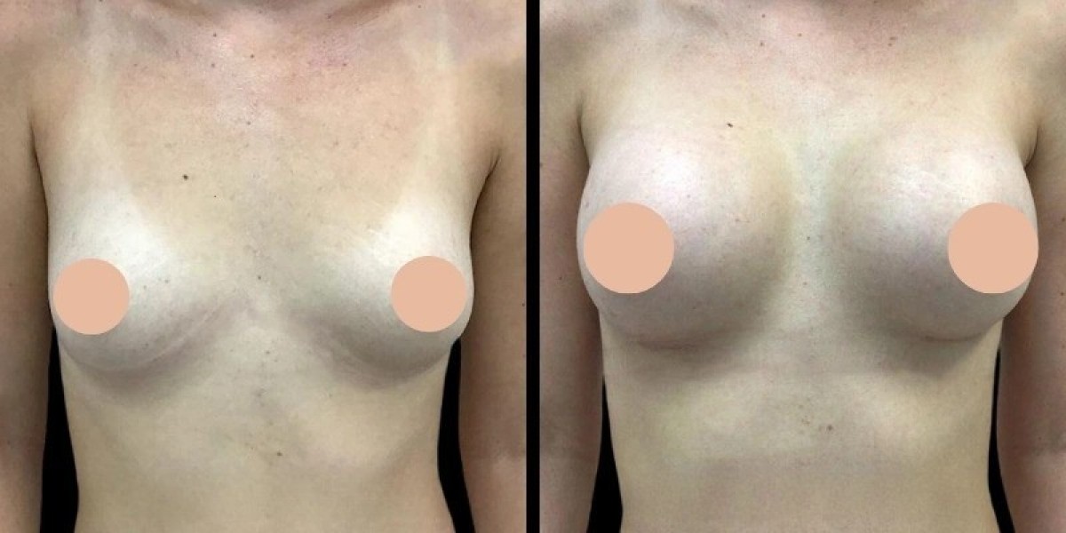 Breast Augmentation in Dubai: A Complete Guide to the Recovery Process