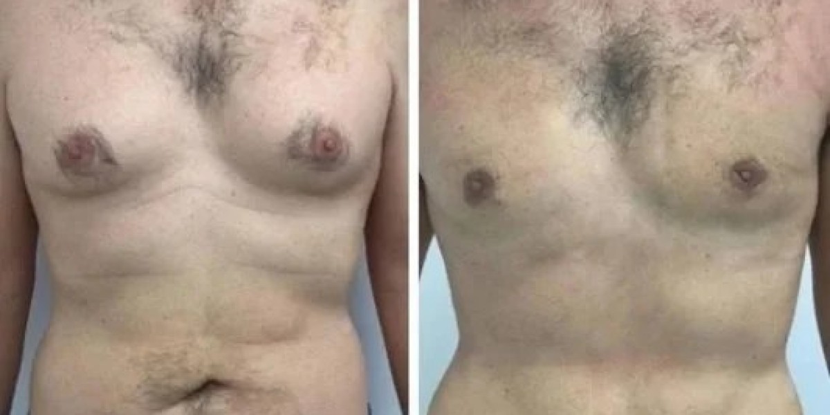 Gynecomastia in Dubai: Options and Outcomes