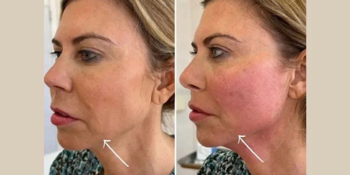 Best Plastic Surgeons in dubai for Endolift Cheek Contouring