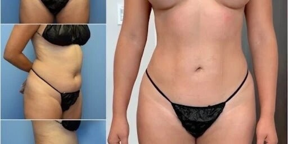 Body Contouring in Dubai: Advanced Solutions for Excess Skin and Fat