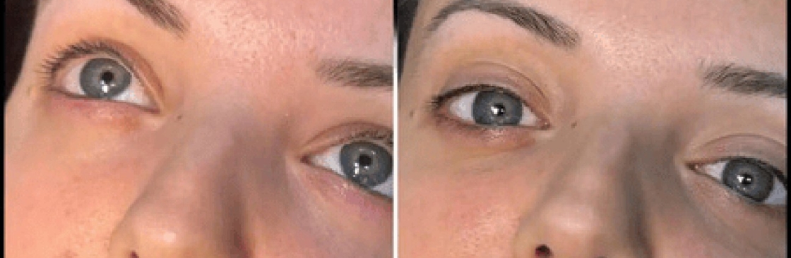 dermal fillers Cover Image