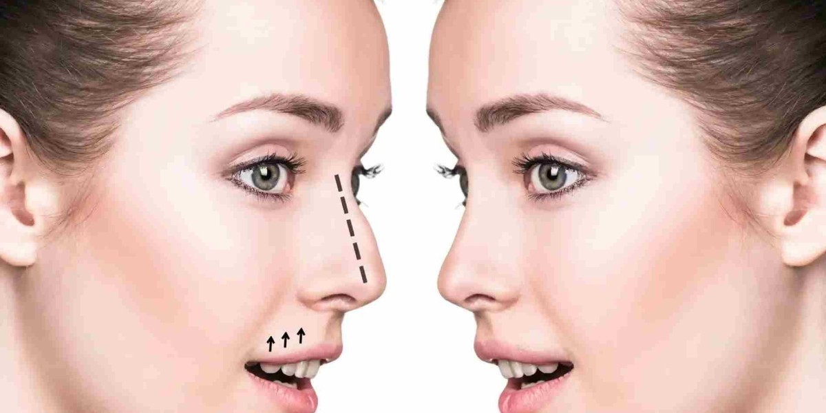 Rhinoplasty in Dubai: What to Expect From Consultation to Recovery
