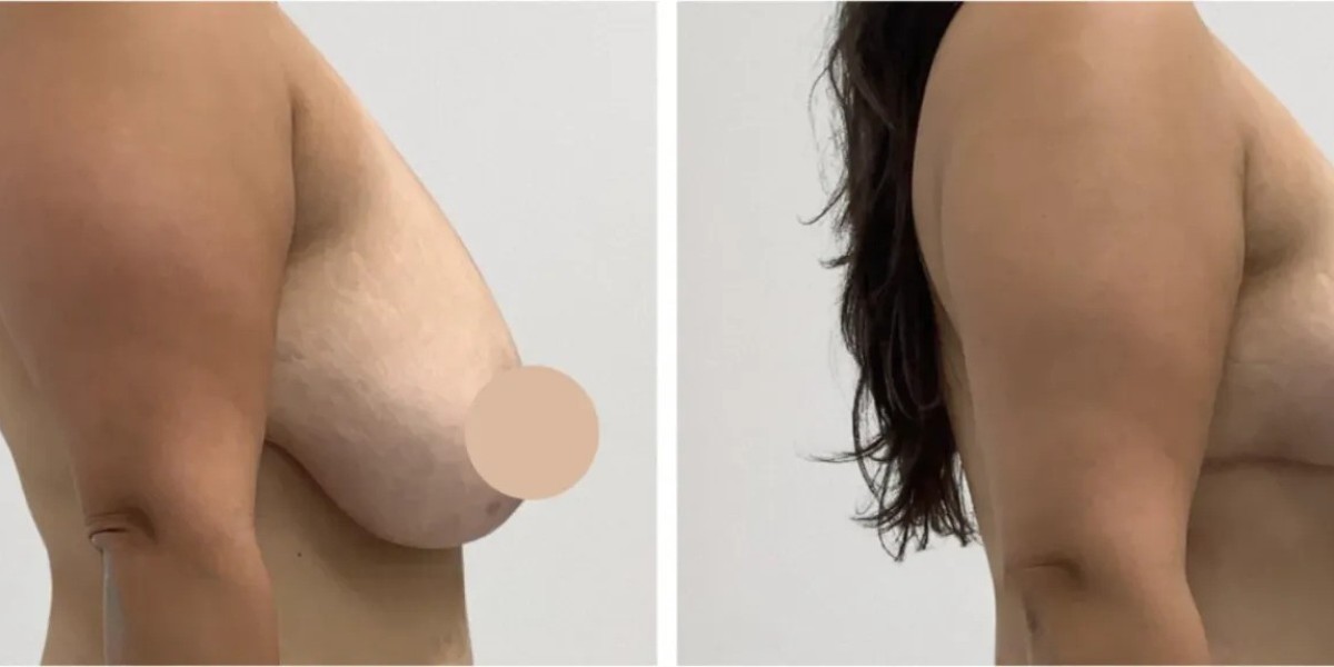 Breast Lift in Dubai: Harmonious Silhouette and Professionally Planned Results