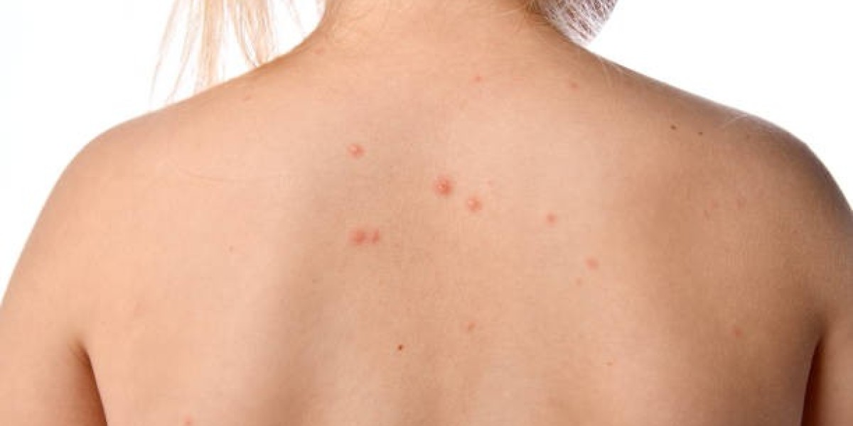 How to Treat Back Acne With Post Exercise Skin Care