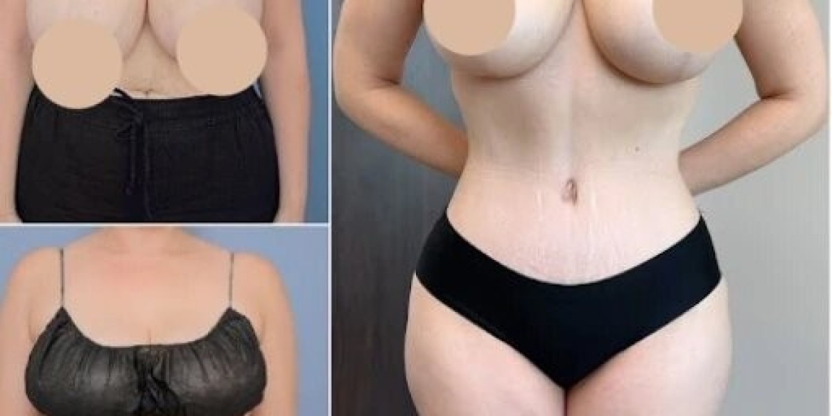 Tummy Tuck in Dubai: Create a Balanced and Harmonious Body Shape