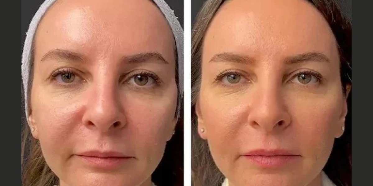 Best Doctors in Dubai for Mesotherapy Cost and Treatment Factors