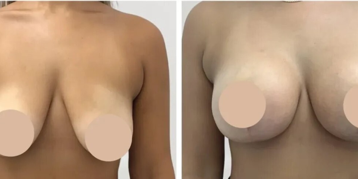 Breast Reduction in Dubai: Personalized Surgical Planning for Beautiful Contours