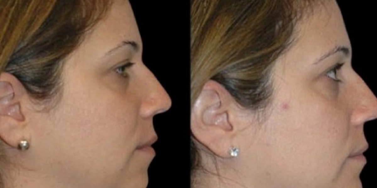 Double chin removal in Dubai Cosmetic Success