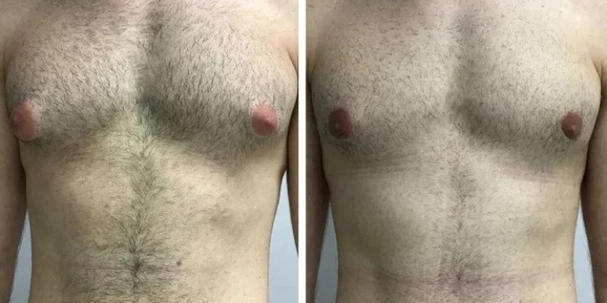 Exploring Natural Chest Contours After Gynecomastia in Dubai