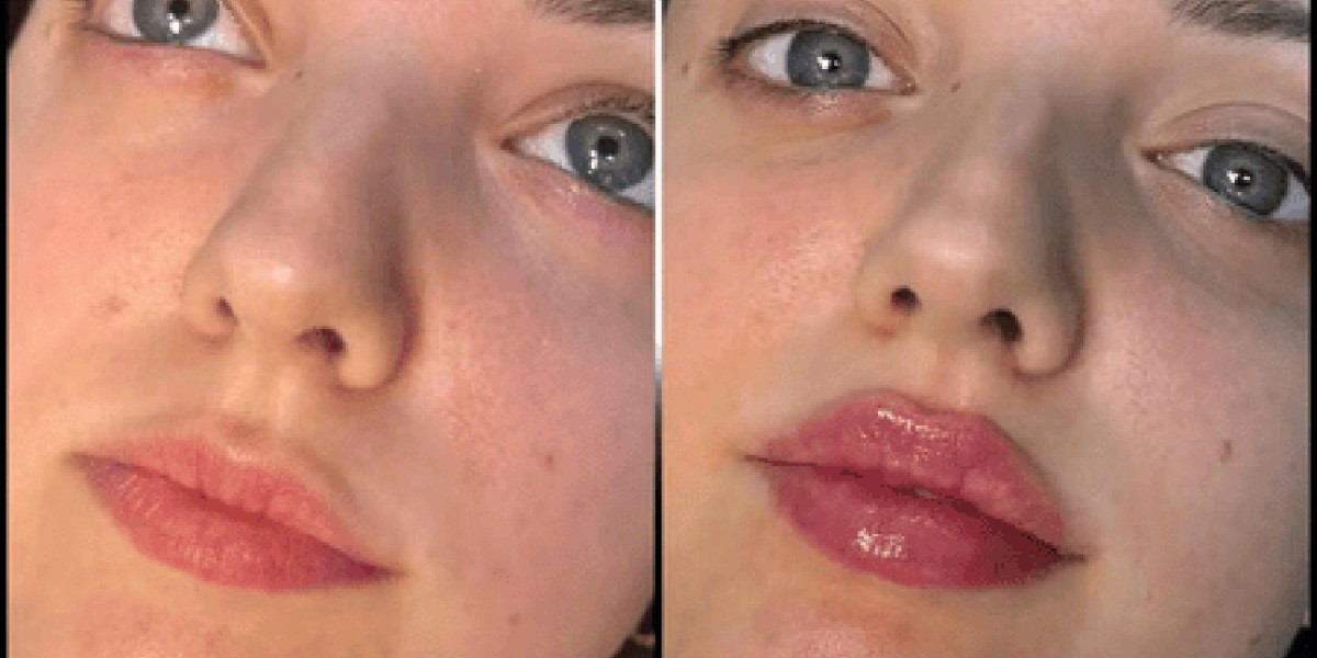 Best Aesthetic Clinic in dubai: The Most Popular Fillers for Every Need