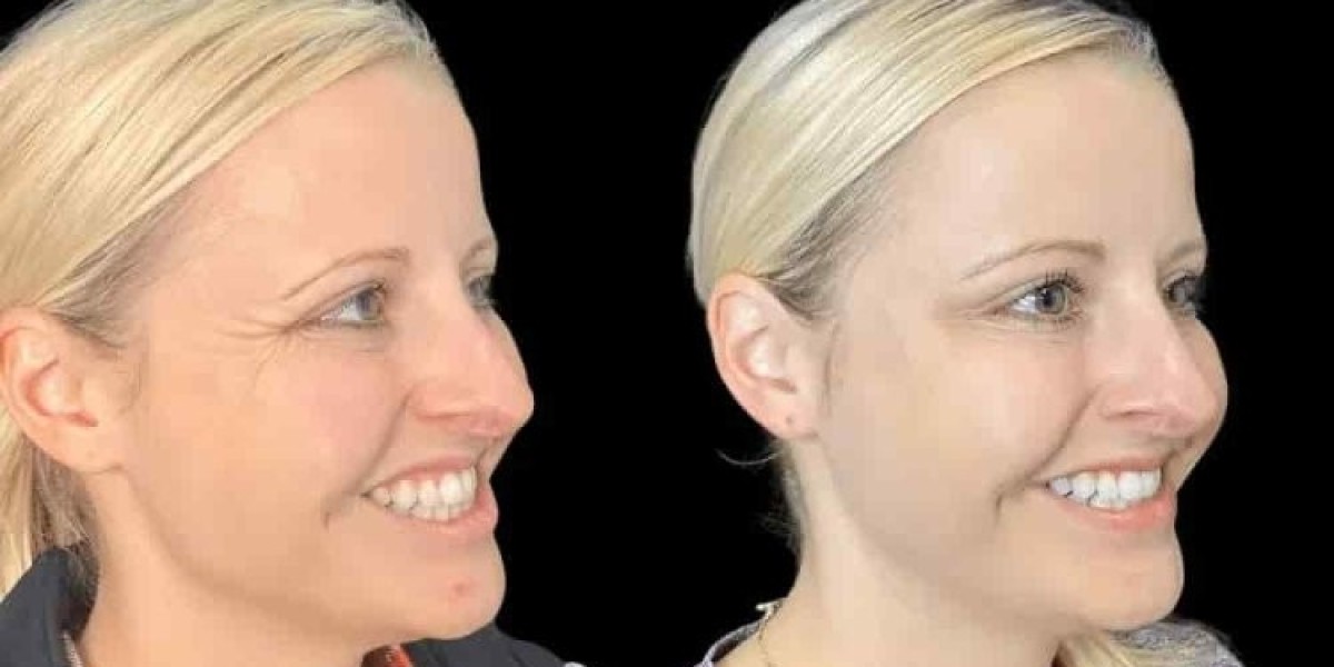 Best Doctors in Dubai for Botox: Important Factors for Informed Decisions