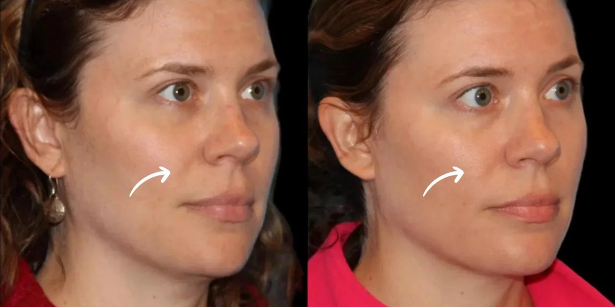 Best Doctors in Dubai: Sculptra and Session Design
