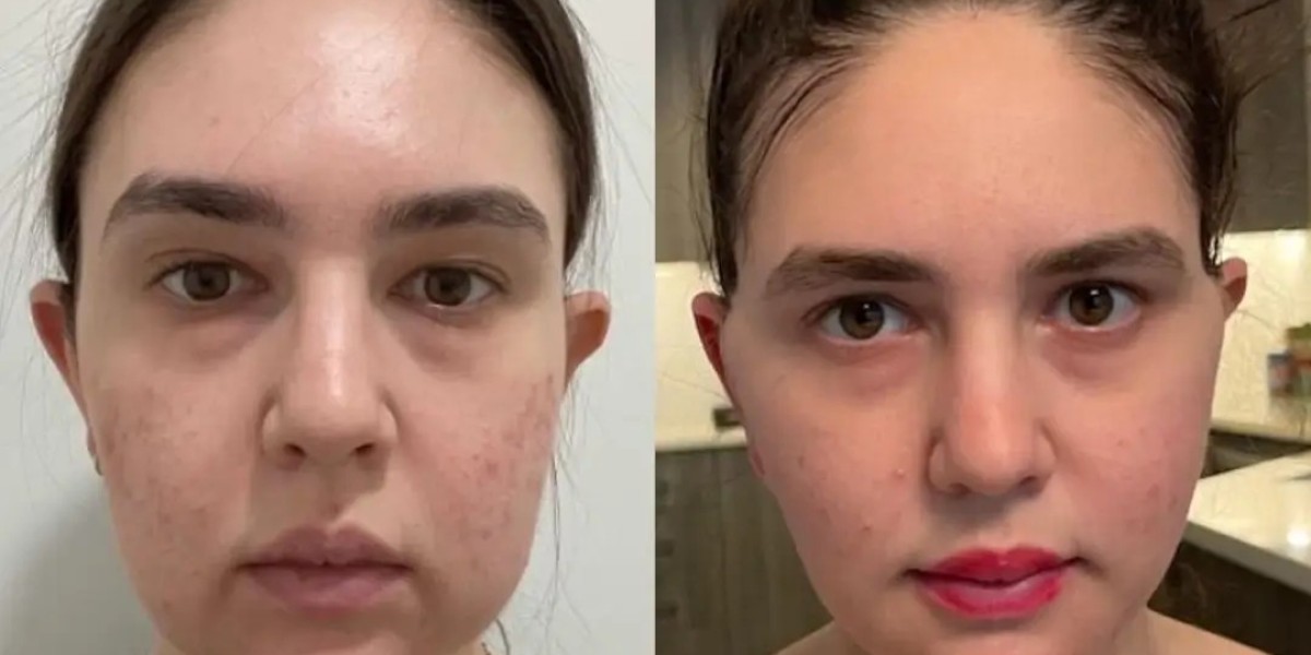 Buccal fat removal in Dubai Beauty Goals